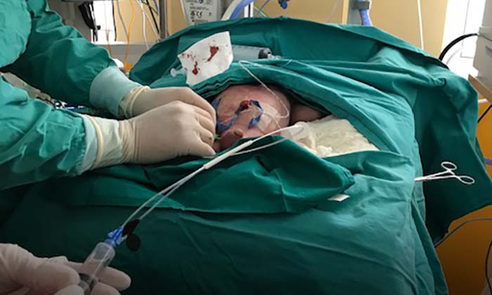 Hospital Regional salvó la vida de bebé con este exitoso procedimiento